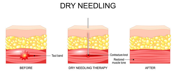 Dry needling: taut band before treatment, needle at the contracture knot, and restored muscle tone after